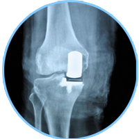 Uni-Knee Replacement